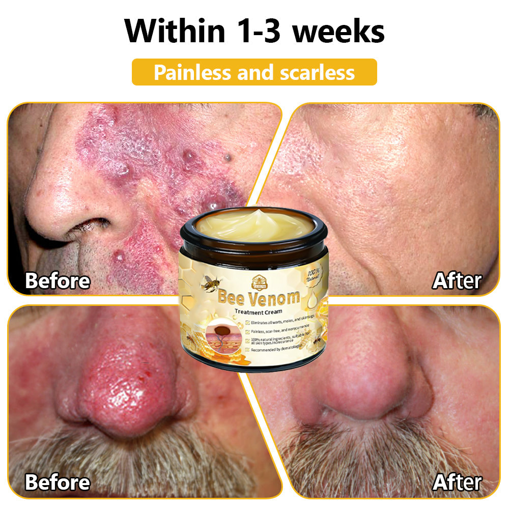 ๐ง๐๐ข๐ฃ๐ยฎ Bee Venom Skin Treatment Cream (AAD Recommended๐จโโ๏ธ)๐๐
