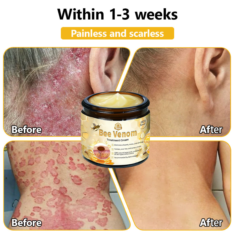 ๐ง๐๐ข๐ฃ๐ยฎ Bee Venom Skin Treatment Cream (AAD Recommended๐จโโ๏ธ)๐๐