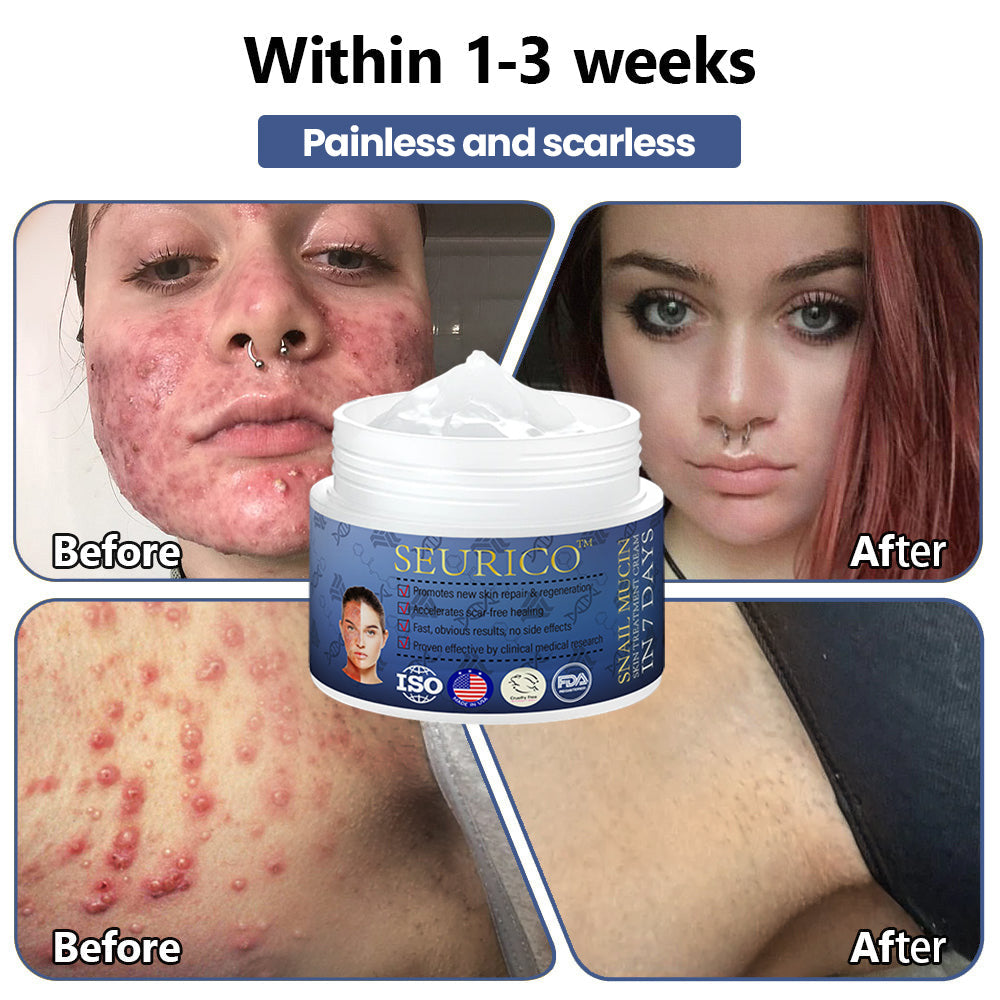 Seurico™ Snail Mucin Skin Treatment Cream (AAD Recommended👨⚕️)💖💟