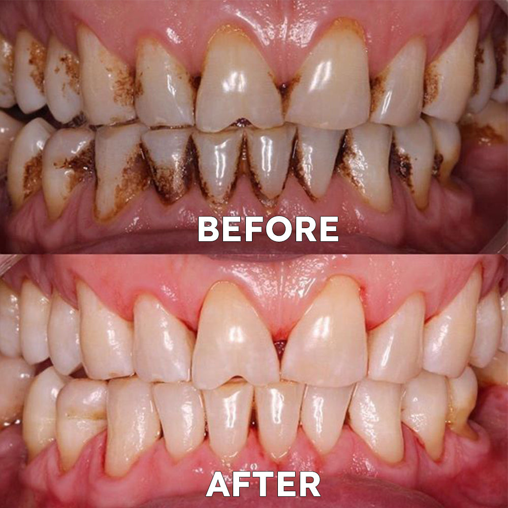 ✅Official Store | Ourlyard™ Tooth Health Mineral Powder🧑🏽‍⚕️TGA-Certified (for the treatment of periodontitis and oral ulcers, prevention of tooth loss, and repair of gum recession)