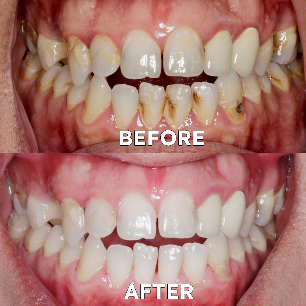 ✅Official Store | Ourlyard™ Tooth Health Mineral Powder🧑🏽‍⚕️TGA-Certified (for the treatment of periodontitis and oral ulcers, prevention of tooth loss, and repair of gum recession)