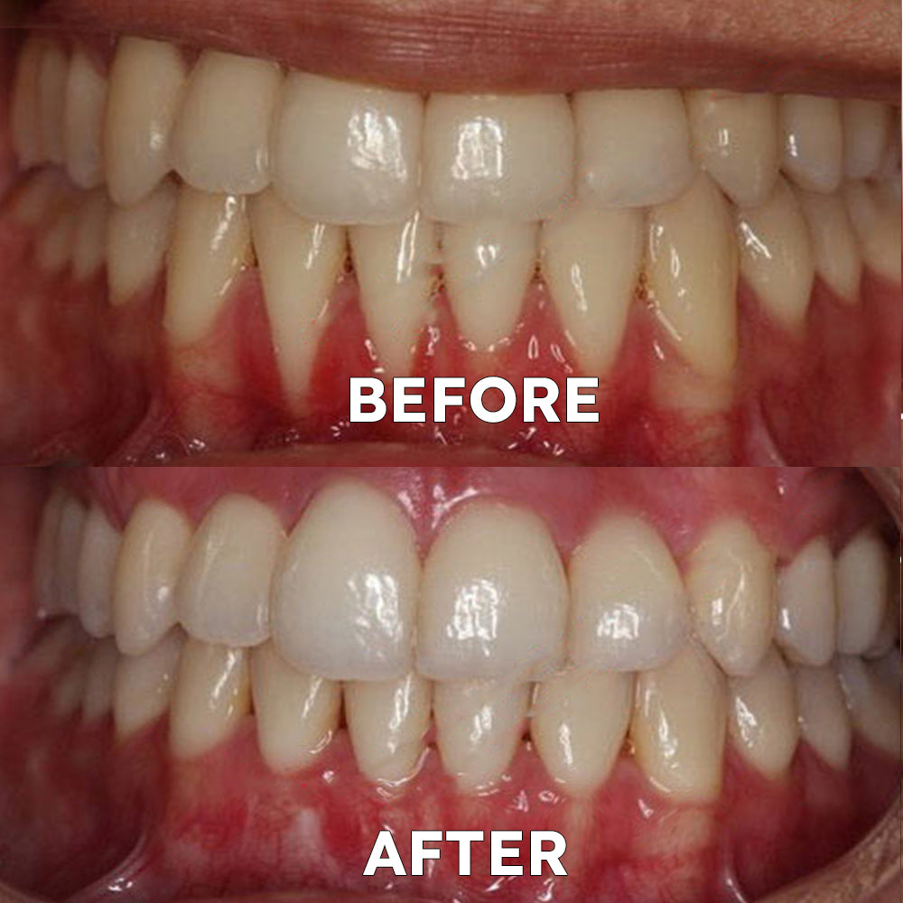 ✅Official Store | Ourlyard™ Tooth Health Mineral Powder🧑🏽‍⚕️TGA-Certified (for the treatment of periodontitis and oral ulcers, prevention of tooth loss, and repair of gum recession)