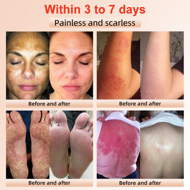 ✨𝐋𝐚𝐬𝐭 𝐃𝐚𝐲 𝐃𝐢𝐬𝐜𝐨𝐮𝐧𝐭: 90% 𝐎𝐅𝐅🔥 Seurico™ Exfoliating Gel